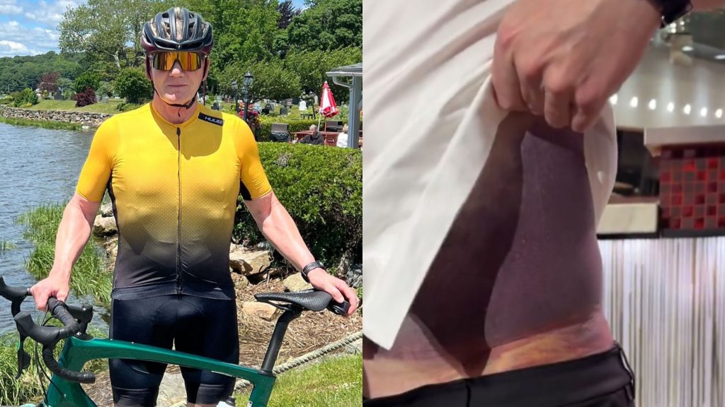 Γκόρντον Ράμσεϊ: Οι τεράστιες μελανιές μετά από ατύχημα με το ποδήλατο