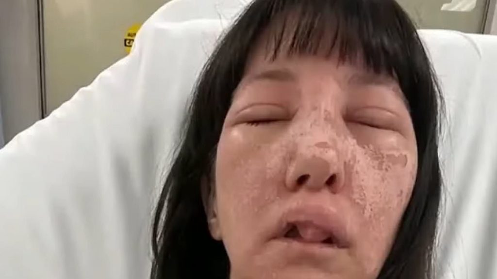 Γεωργία: Γυναίκα δέχθηκε επίθεση από δηλητηριώδεις αράχνες και παραμορφώθηκε το πρόσωπό της – Σοκαριστικές εικόνες
